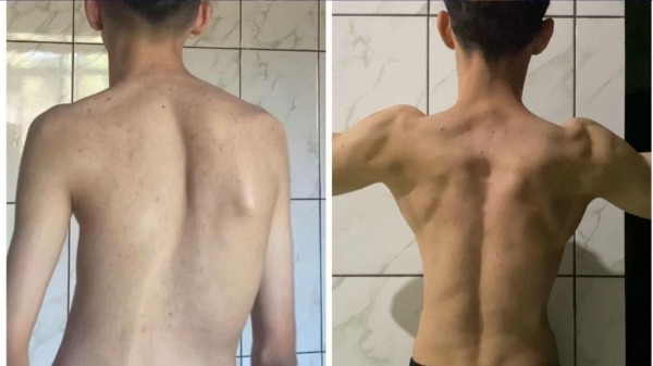 Imagem da notícia sobre Jogador de Free Fire viralizou nas redes sociais após superar Escoliose